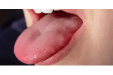 Dil İltihabı Belirtileri ve Tedavisi