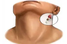 Lenf Bezi İltihabı Belirtileri ve Tedavisi