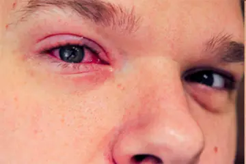 Göz İltihabına Ne İyi Gelir?