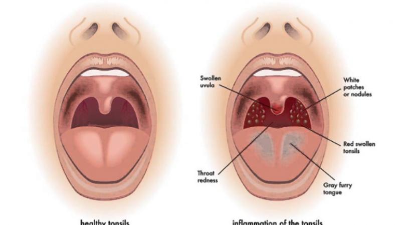 Bademcik İltihabı Belirtileri ve Tedavisi