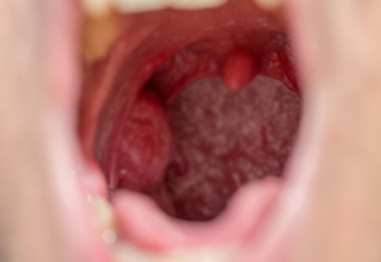 Bademcik İltihabına Ne İyi Gelir?