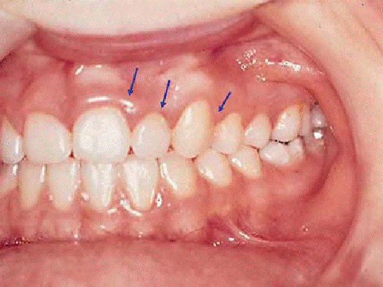 Diş Eti İltihabı Nasıl Geçer?