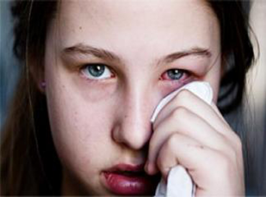 İris İltihabı Belirtileri ve Tedavisi