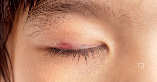 Kirpik Dibi İltihabı Belirtileri ve Tedavisi