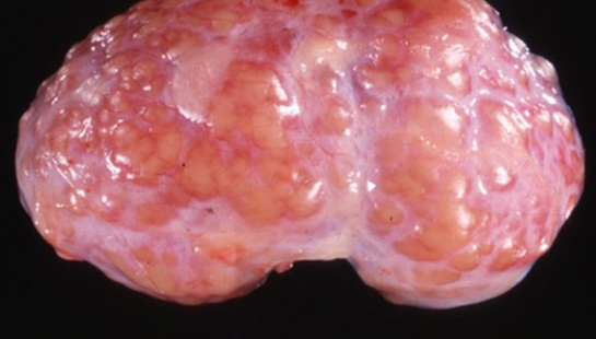 Mide İltihabı Belirtileri ve Tedavisi