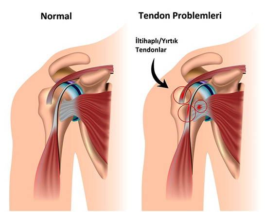 Tendon İltihabı Belirtileri ve Tedavisi