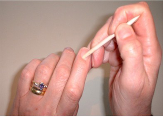 Tırnak Dibi İltihabı Belirtileri ve Tedavisi