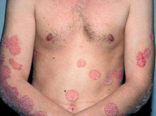 Vücutta İltihap Belirtileri ve Tedavisi